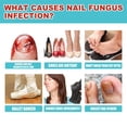 thumbnail image 4 of 16 Uds parche de reparación de infecciones parche de corrección de uñas de los pies sin pegamento para reparación de uñas de los pies, 4 of 7