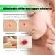 thumbnail image 4 of Melanin Removal Nursing Soap Safe Mild Handmade Soap Brightening Wart Removal Soap, 4 of 4