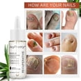 thumbnail image 3 of Suero para el cuidado de las uñas con hongos, loción de esencia para reparación de uñas gruesas y suaves, tratamiento blanqueador de dedos de los pies, 3 of 5