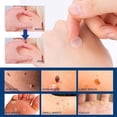 thumbnail image 2 of Parche para eliminar verrugas para todo tipo de piel, elimina lunares, callos y verrugas planas en el cuello, cubierta con parche para eliminar verrugas faciales, 2 of 8