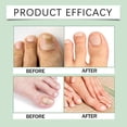 thumbnail image 3 of Anti-Fungals Nail Repair Spray Quick Absorption Nail Strengthening Liquid Nails Care Supplies, 3 of 5