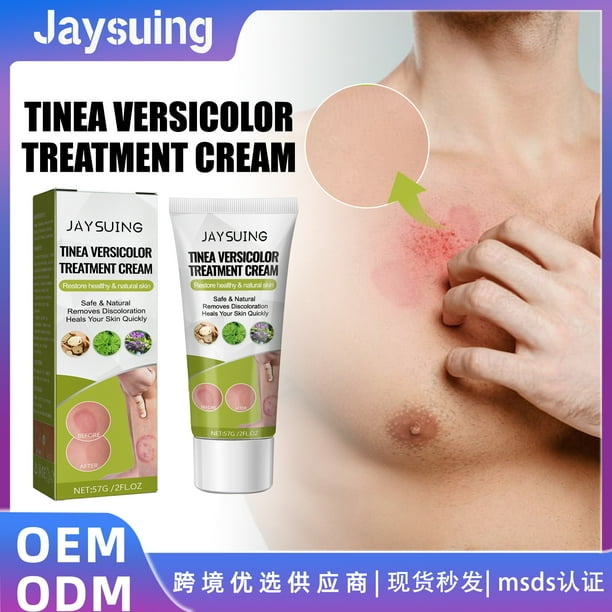 Roycederm Tinea Versicolor Treatment, Antifungal Cream for Tinea