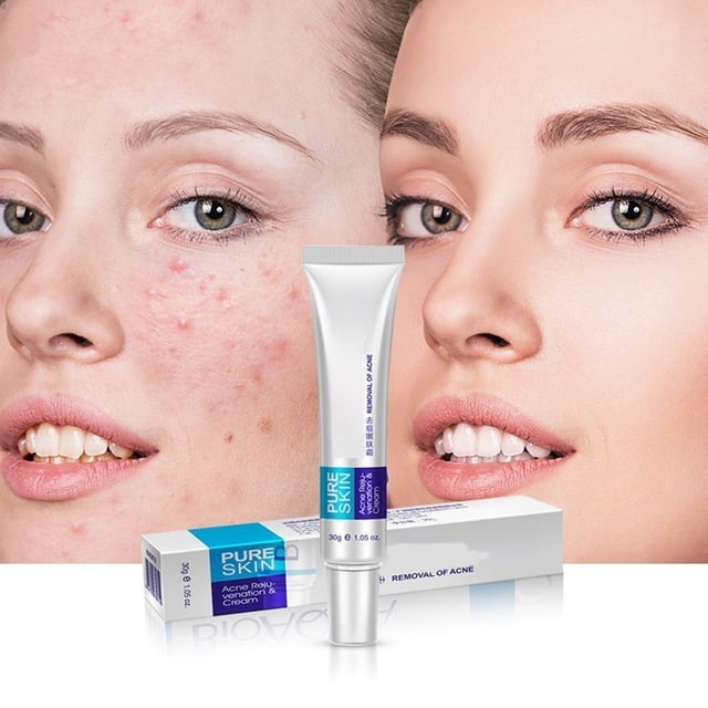 Crema Antimanchas Blanqueadora, Eliminación De Manchas, Pomada Para Espinillas, Marca De Cicatriz, Crema Blanqueadora ANGGREK Descripción de la referencia