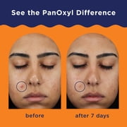 PanOxyl Acne Clearing Spot Treatment, 10% Benzoyl Peroxide, 1 oz