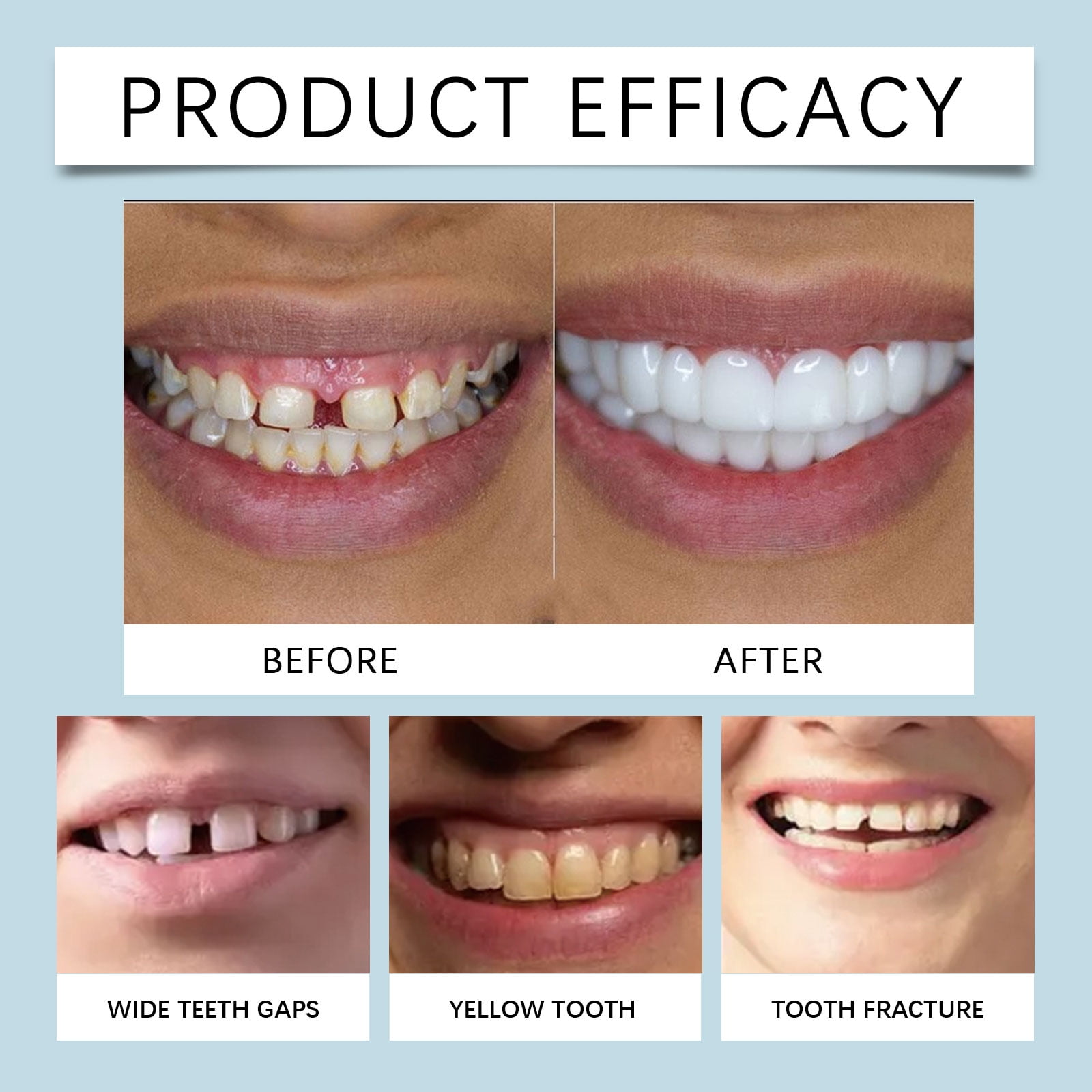 LONRYD Veneers Invisible Teeth Aligners Adjustable Snap-On Dentures for Quick Results