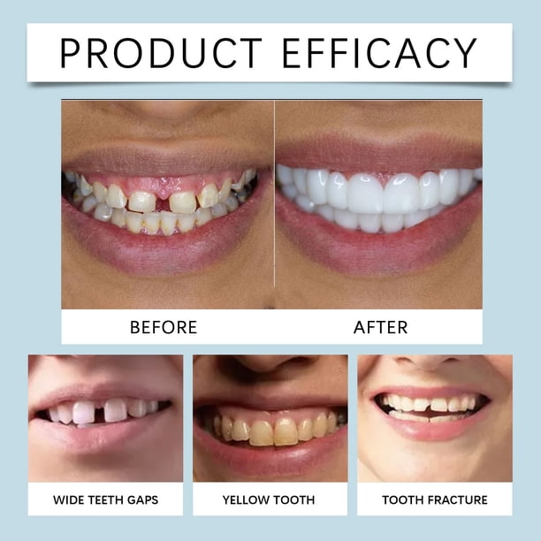 Invisible Teeth Aligners Veenora Clip-On Veneers Adjustable Snap