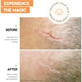 thumbnail image 4 of Strataderm Scar Reducing Treatment Gel 1.75 oz, 4 of 7