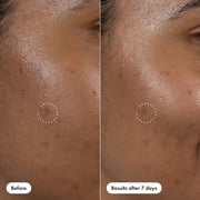 Hero Cosmetics Dark Spot Correct, Vitamin C Serum for Post-Blemish Dark Spots, 10ml