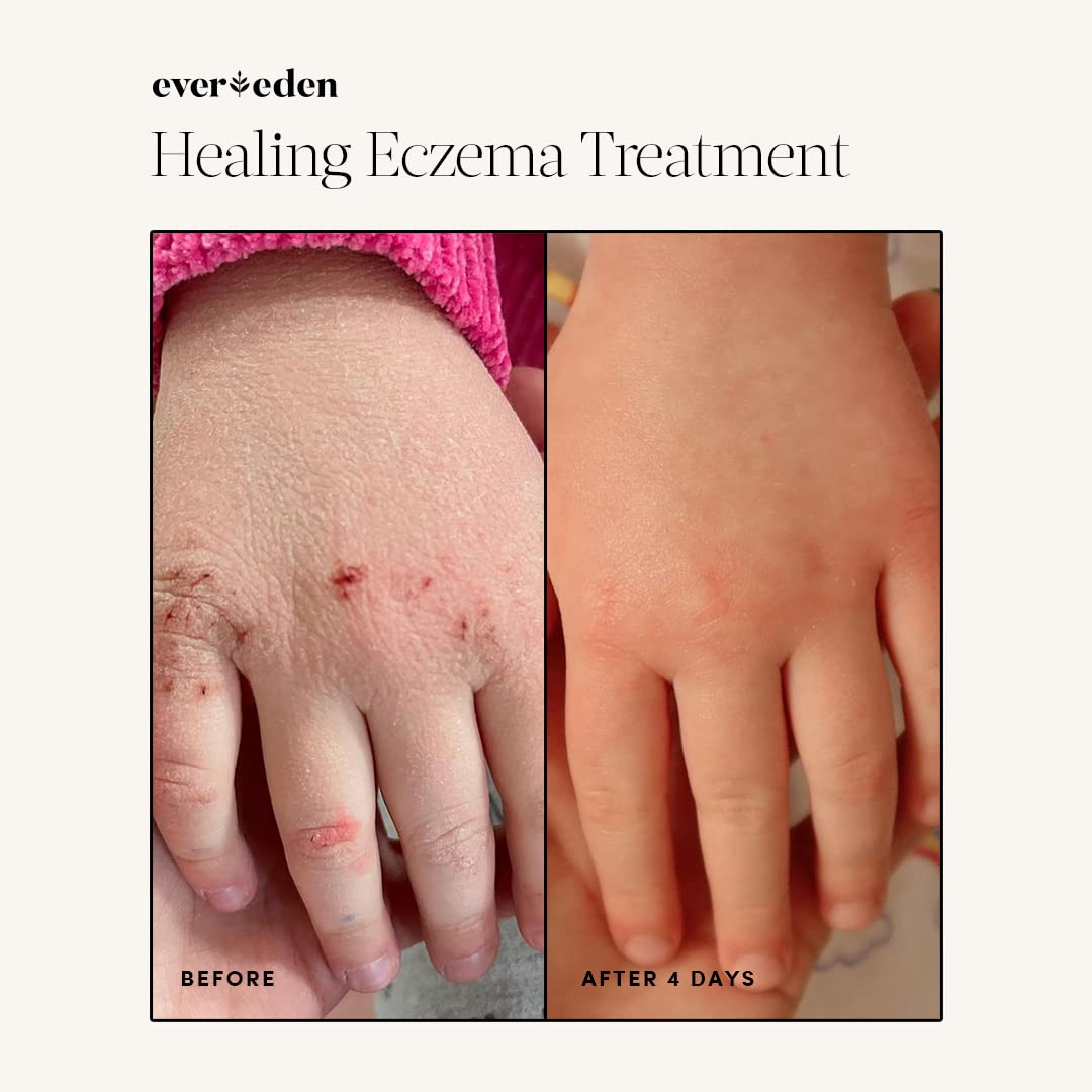 Evereden Healing Eczema Treatment, 1.7 fl oz | Safe & Efficient Eczema Cream | Gentle & Fragrance Free Eczema Cream for Babies, Kids, and Adults
