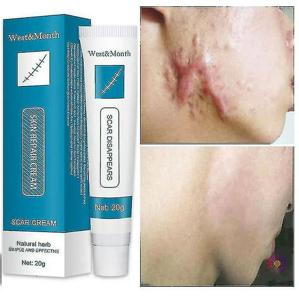 Crema reparadora de cicatrices, Gel para eliminar cicatrices de acné, estrías que se desvanecen, manchas de acné, tratamiento de cicatrices quirúrgicas, suero suave para el cuidado de la piel del cuer