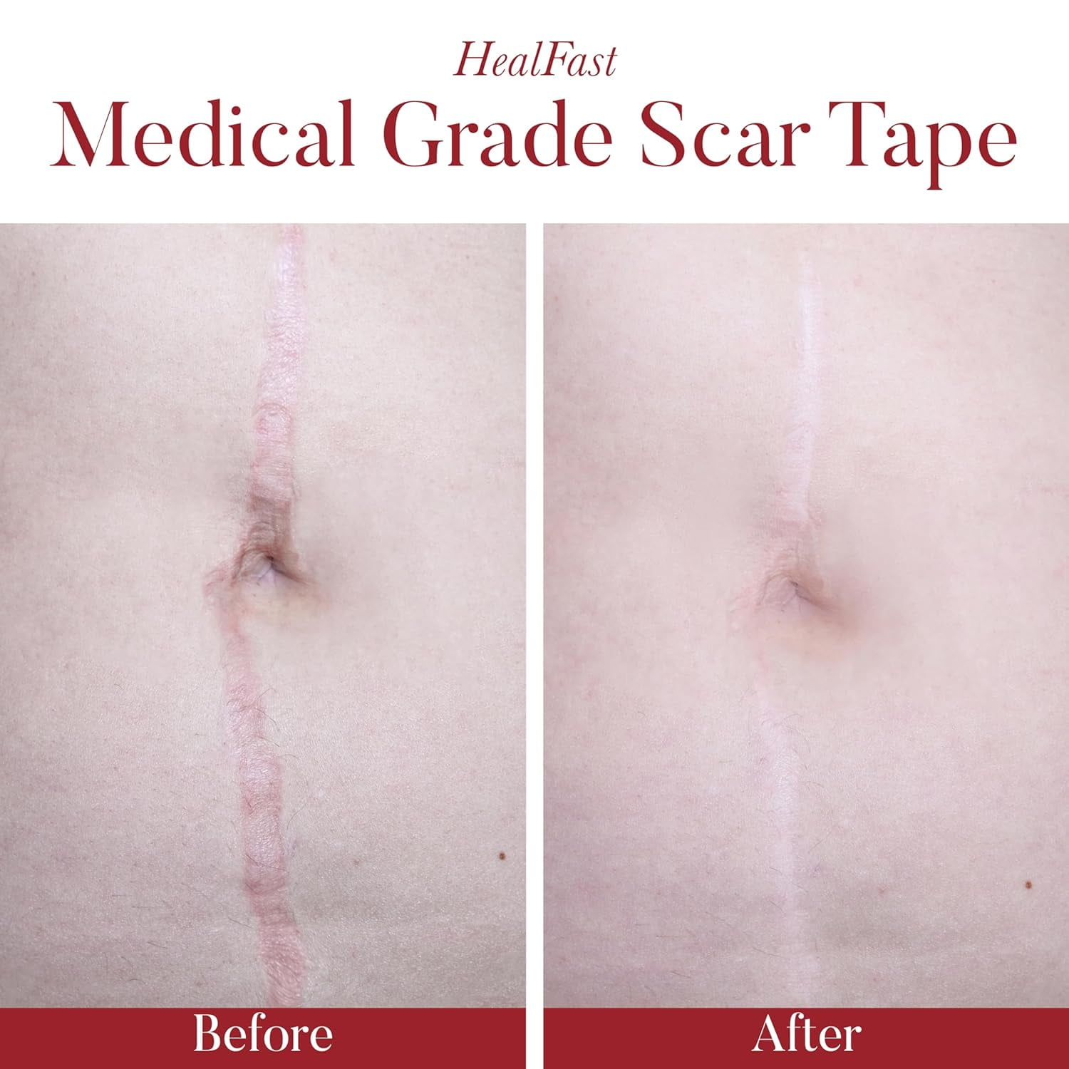 Physician Formulated Silicone Scar Sheets - Advanced Crosspolymer Medical Grade Silicone Scar Tape for Surgery, C Section, Keloids & Hypertrophic Scars - Silicone Tape For Scars - Scar Patches