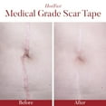 thumbnail image 4 of Physician Formulated Silicone Scar Sheets - Advanced Crosspolymer Medical Grade Silicone Scar Tape for Surgery, C Section, Keloids & Hypertrophic Scars - Silicone Tape For Scars - Scar Patches, 4 of 6