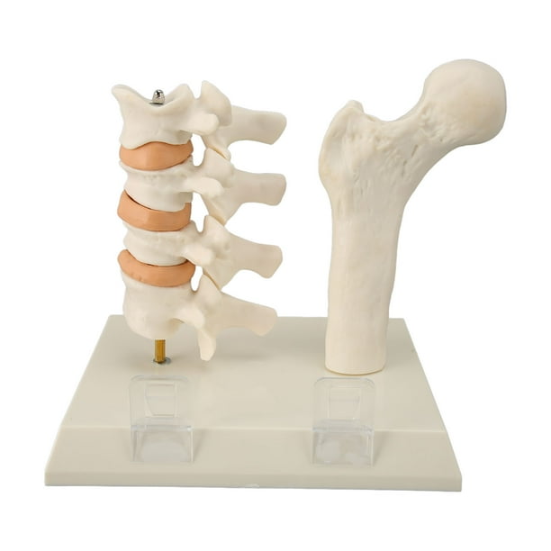Modelo de columna vertebral de osteoporosis que demuestra el modelo educativo de lesión de osteoporosis para la enseñanza clínica ANGGREK Otros