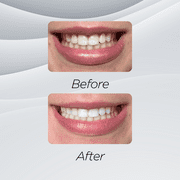 White Glo Professional Choice Whitening Toothpaste, Fluoride Toothpaste for Stain Removal and Daily Care