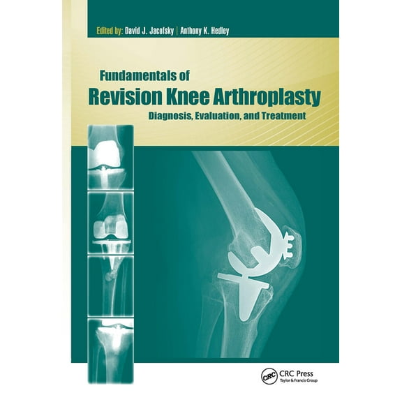 Fundamentals of Revision Knee Arthroplasty: Diagnosis, Evaluation, and Treatment, (Hardcover)