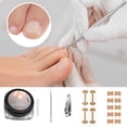 thumbnail image 2 of STAOEDU 40 Pack Professional Ingrown Toenail Correction Treatment Kit, 40 Pcs Ingrown Toenail Corrector Straightener Strips Recover Clips with Ingrown Toenail File, 2 of 5