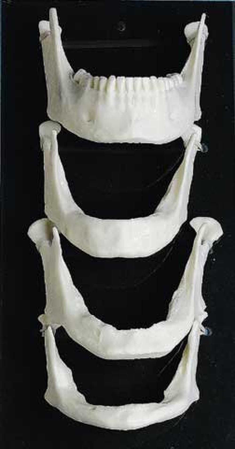 Kilgore Edentulous Mandibles Dental Patient Models