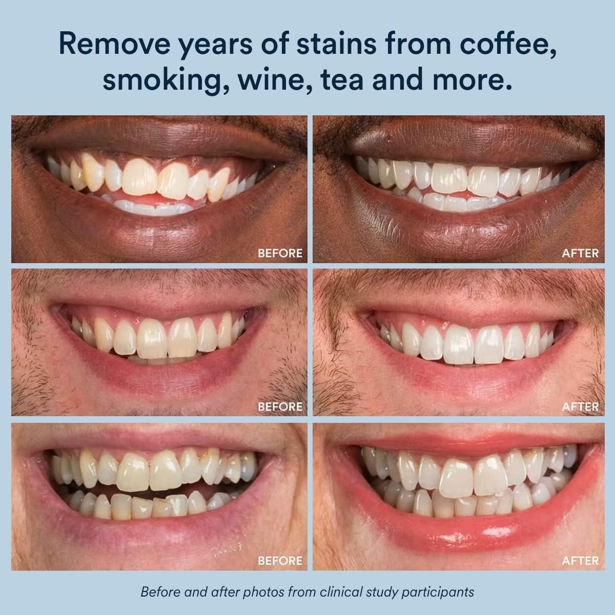 Auraglow Teeth Whitening Gel Refill, 35% Carbamide, 30 Treatments photo 6