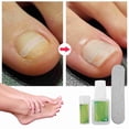thumbnail image 4 of Kit De Eliminación De Uñas Encarnadas, Kit Profesional De Corrección De Uñas Encarnadas Con Barra De Esmalte Y Pegamento Para Uñas, Parches Elásticos Para Un Crecimiento, 4 of 7