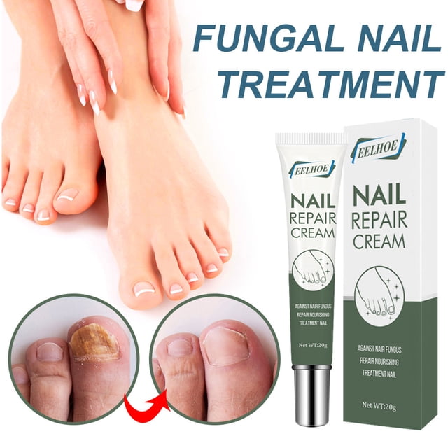 Gel de crema para uñas antiinfección crema para eliminar hongos en las uñas cuidado de los pies removedor de callos