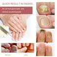thumbnail image 3 of ISTAR 3ml Nail Repair Fluid Anti Infection Paronychia Essence Effective for Foot Care, 3 of 5