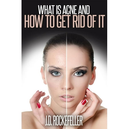What is Acne and How to Get Rid of It - eBook (Best Cream To Get Rid Of Acne Scars)