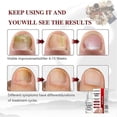 thumbnail image 4 of Nail Care Renewal Liquid for Thick Damage Discolored Nails, Fast-Acting Antifungals Repairs Discolored Nails, for Nails Care Supplies, 4 of 5