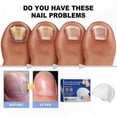 thumbnail image 2 of Gentle Nail Care Tool for Health and Repair, 2 of 5