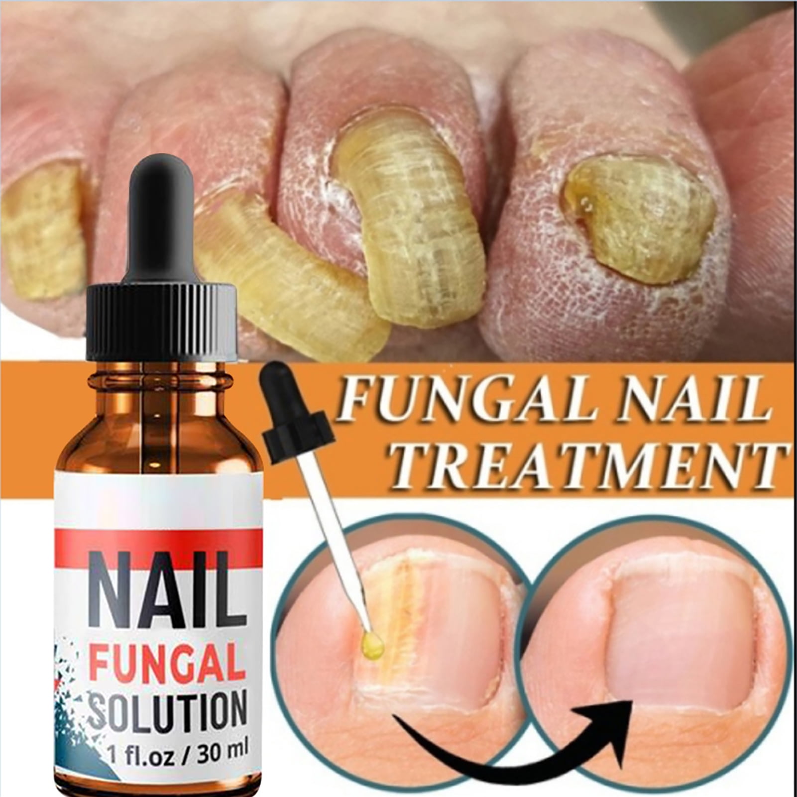 Nail-Plus Fungal Nail Treatment - Stops Toenail, Finger, Fungus Infections  10ml | eBay