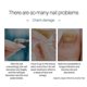 thumbnail image 4 of Lápiz reparador de uñas para piel muerta, padrastros y onicomicosis: cuidado nutritivo de las uñas, 5 unidades, 4 of 4