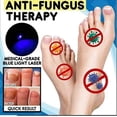 thumbnail image 4 of 2pcs Anti-fungal Home Treatment Set Toenail Treatment Pen, Onychomycosis Repair Laser And Pen,quick And Visible, Safe And Easy T, 4 of 5