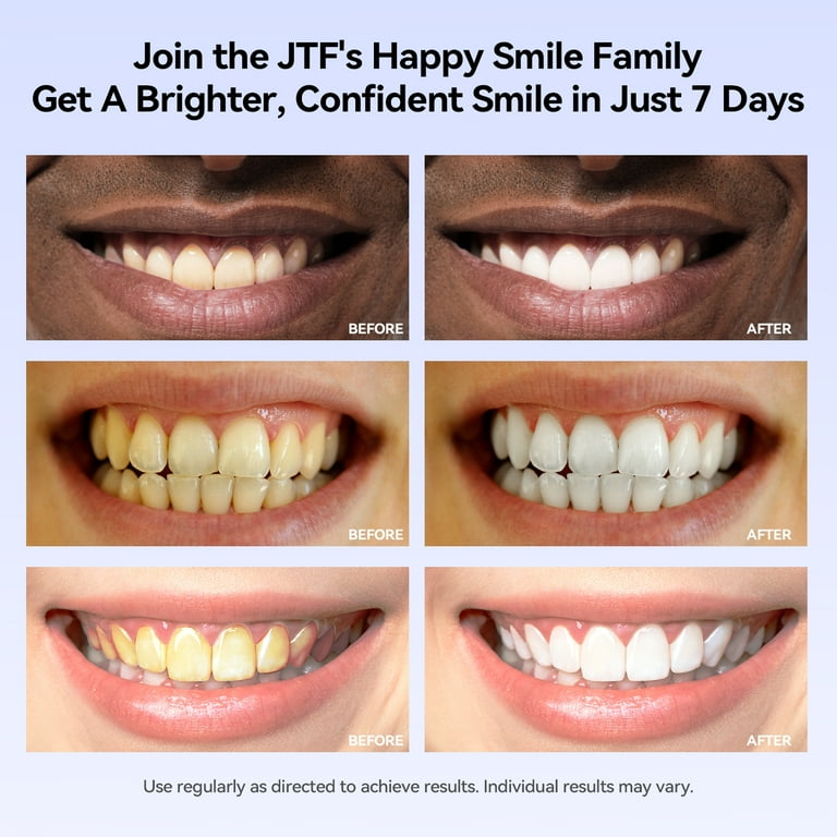 JTF 6-Pack Teeth Whitening Gel Refills Kit, 5 Whitening Gels