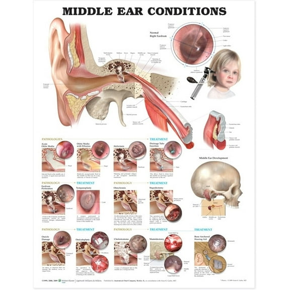 Middle Ear Conditions Anatomical Chart
