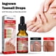 thumbnail image 3 of FeiKong Tratamiento para uñas encarnadas de 30 ml, tratamiento para el crecimiento de las uñas, gotas para uñas encarnadas, aceite para cutículas y corrección de uñas encarnadas, 3 of 5