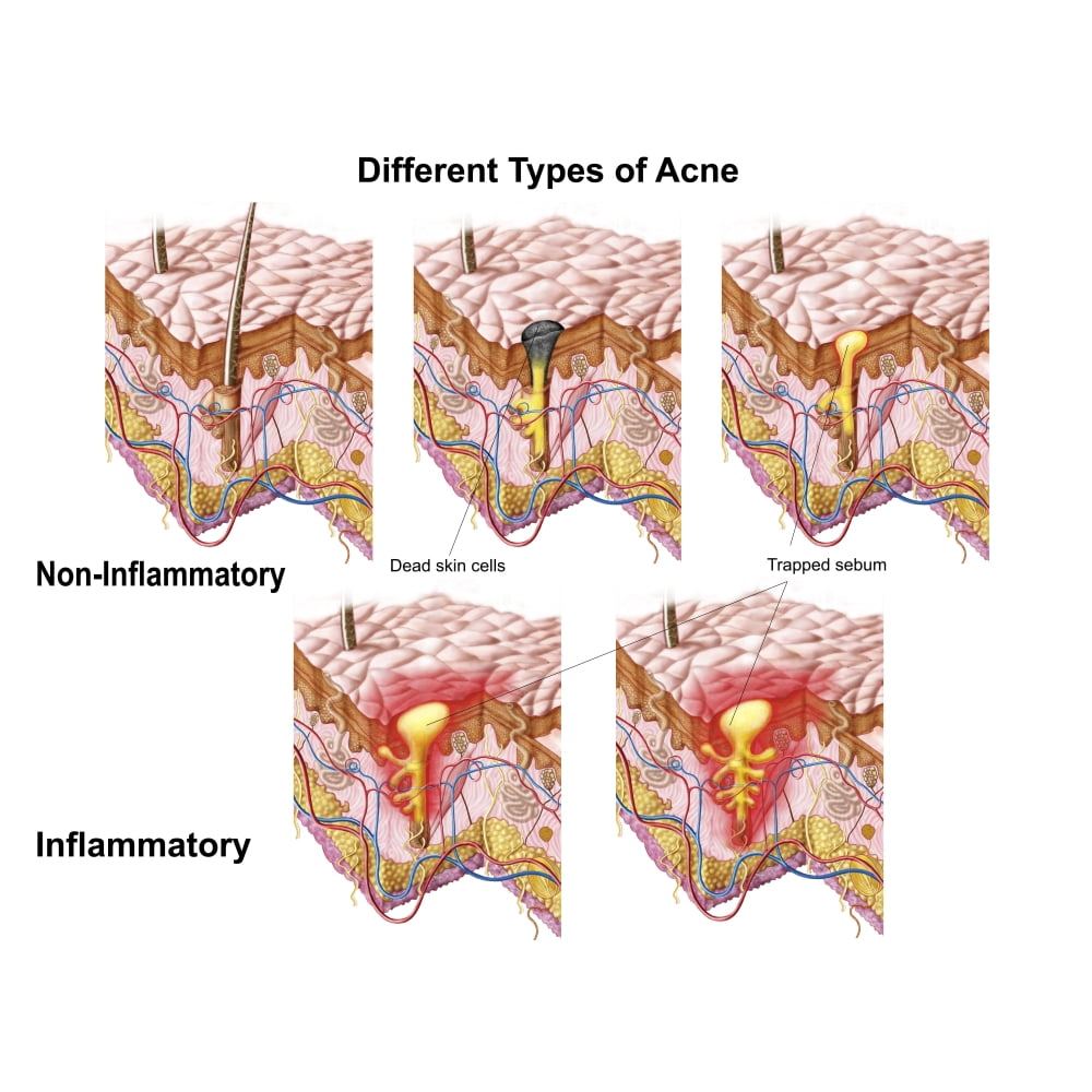 Different types of acne, non-inflammatory and inflammatory Poster Print ...