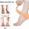 thumbnail image 6 of 2 Pair Silicone Heel Protector, Strong and Breathable Heel Protectors, Heel Cups for Fast Heel Pain Relief, Plantar Fasciitis Support, Blister, Spur Relief for Men and Women, 6 of 7
