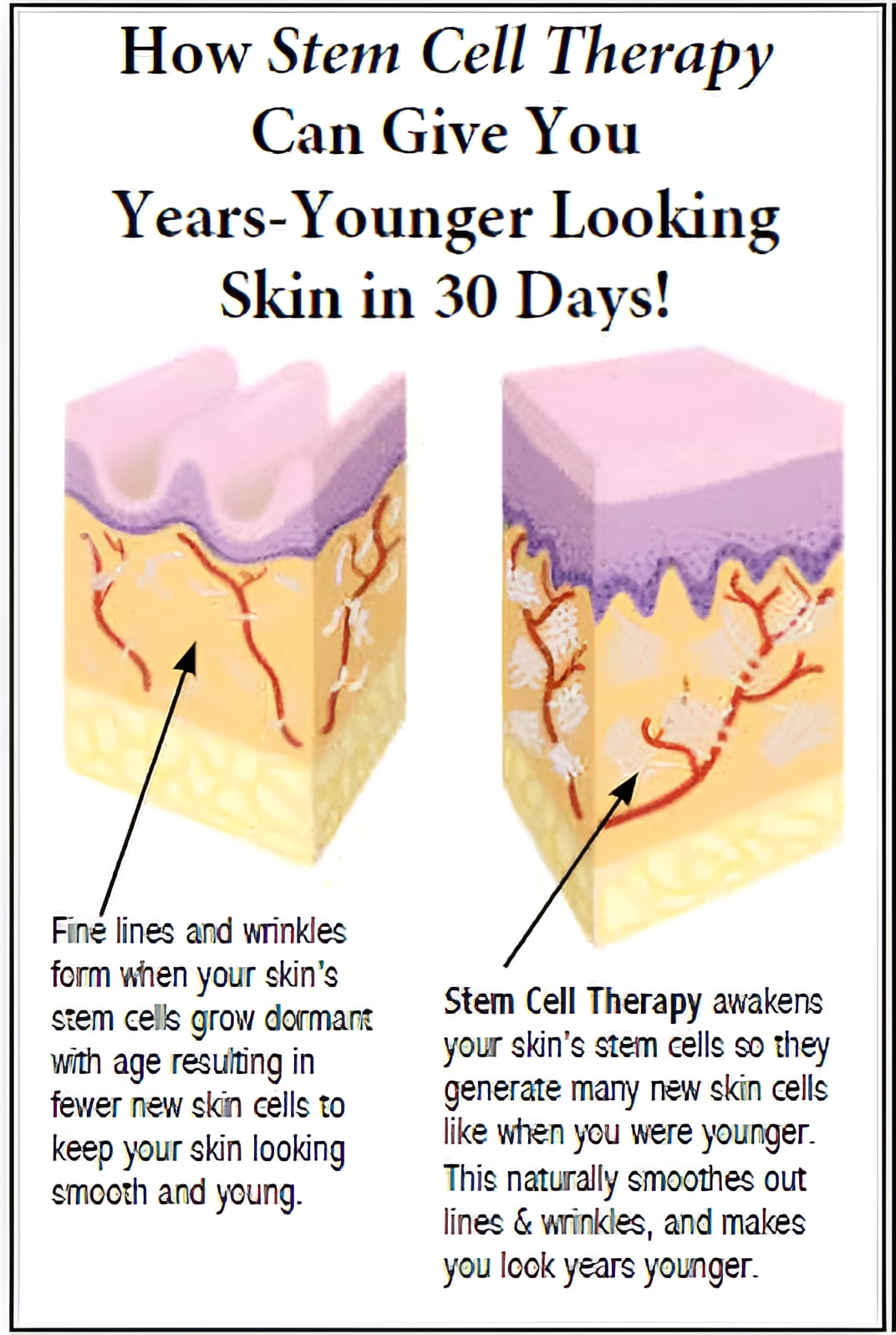 Stem Cell Therapy works to give you more youthful looking skin and reduce the appearance of wrinkles.