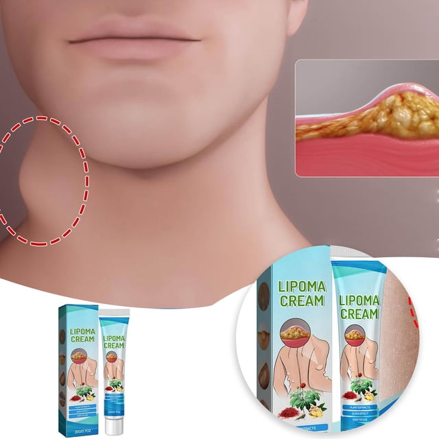 Fatty Knot Fatty Knot Subcutaneous Lumps Dredging And Dispersing Knot Body Care Oily Skin Skin Care Products Watermelon Shampoo Face Roller Natural Beauty Products Three Trees Dry Skin Skin ning Soap
