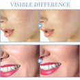 thumbnail image 4 of Máquina facial de alta frecuencia - TUMAKOU Máquina portátil de varita para la piel facial de alta frecuencia con 4 tubos diferentes, 4 of 5