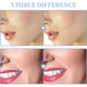 thumbnail image 4 of Máquina facial de alta frecuencia - TUMAKOU Máquina portátil de varita para la piel facial de alta frecuencia con 4 tubos diferentes, 4 of 5