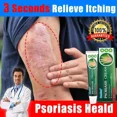 thumbnail image 2 of Tratamiento de hongos antibacteriano para Psoriasis a base de hierbas, alivio de picazón, Eczema, Rash de la piel, Urticaria, descamación, 2 of 5