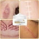 thumbnail image 4 of Scar Removal Cream for New and Old Scars Stretch Mark Removal Gel Ointment for Women and Men, 4 of 4
