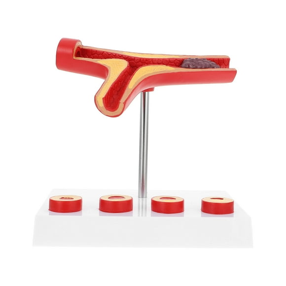 EeaseMX Visualización del modelo anatómico de aterosclerosis cardiovascular Modelo de aterosclerosis