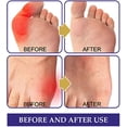 thumbnail image 3 of 15pcs Strong Joints Anti Bunion Patch, Bunion Corrector, Bunion Relief, For Hallux Valgus And Overlapping Toes, 3 of 4