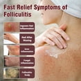 thumbnail image 4 of Folliculitis Treatment Cream, Fast-Acting Relief for Scalp, Face & Body, Soothes Itching, Redness & Inflammation, Natural Colloidal Oatmeal Formula for Sensitive Skin - 3.52oz, 4 of 9