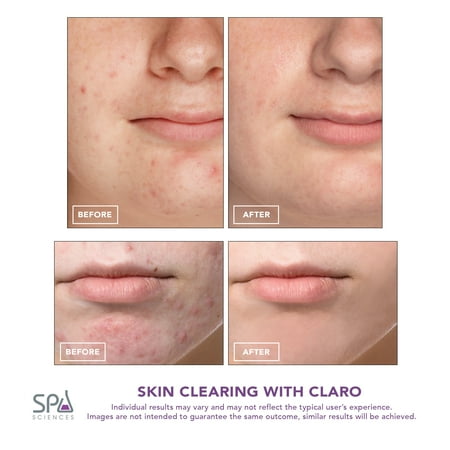 Spa Sciences Claro, LED Acne Clearing Light Therapy System, FDA Cleared and Rechargeable