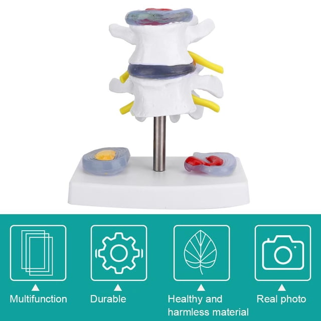 Modelo de Hernia de Disco Lumbar Anatómico Humano, Suministros de Entrenamiento para la Escuela de la Columna Vertebral Humana, Excelente Manera de Demostrar el Disco Saludable Crtynell NO