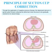 Pectus Excavatum Orthosis Brace with Automatic Air Pump, Pectus Excavatum Vacuum Bell for Sunken Chest, Thoracic Depression Support for All Ages