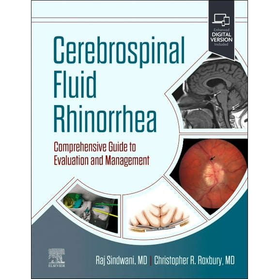 Cerebrospinal Fluid Rhinorrhea: Comprehensive Guide to Evaluation and Management, (Hardcover)