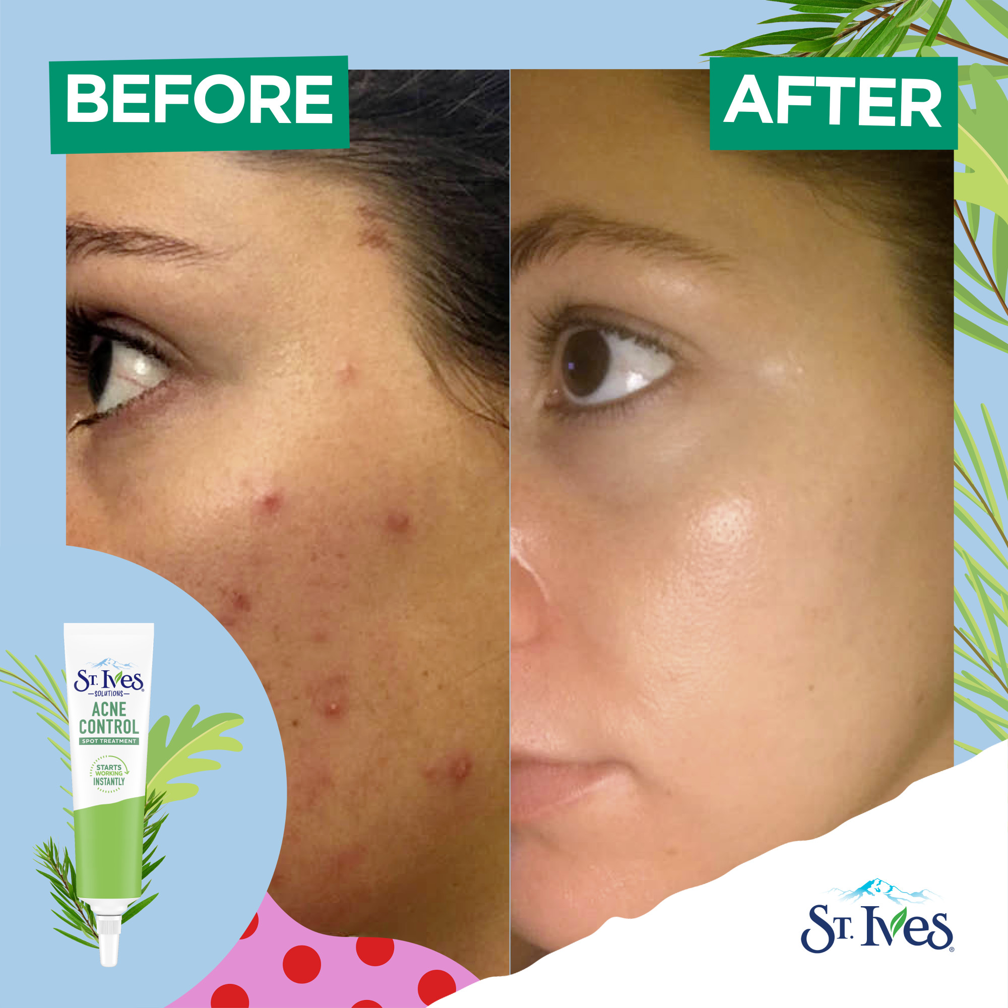 St. Ives Solutions Spot Treatment For Blemish Redness Reduction Acne Control Made with 2% Salicylic Acid and 100% Natural Tea Tree Extract 0.75 oz - image 4 of 16